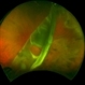 Traumatic Retinal Dialysis Traumatic Retinal Dialysis