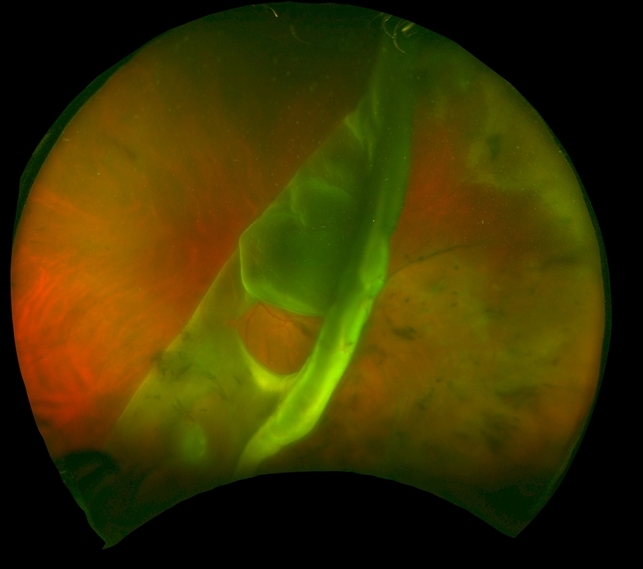 Traumatic Retinal Dialysis - Retina Image Bank