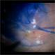 BBG Dye injection to Stain ILM during Vitrectomy Surgery | Intra-Operative Still BBG Dye injection to Stain ILM during Vitrectomy Surgery | Intra-Operative Still