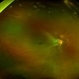 Retinopathy of Prematurity Retinopathy of Prematurity