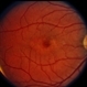 Pattern Dystrophy Pattern Dystrophy