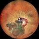 Subhyaloid Hemorrhage with JXT and Proliferative Diabetic Retinopathy Subhyaloid Hemorrhage with JXT and Proliferative Diabetic Retinopathy