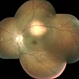 Tubercular Choroidal Granuloma Tubercular Choroidal Granuloma