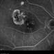 Polypoidal Choroidal Vasculopathy (FA Late Phase) Polypoidal Choroidal Vasculopathy (FA Late Phase)