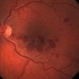 Unilateral Idiopathic Hemorrhagic Retinopathy - Fundus Image