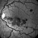 Benign Idiopathic Hemorrhagic Retiopathy - RF Image