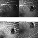 Cavernous Hemangioma Fluorescein Angiography Cavernous Hemangioma Fluorescein Angiography