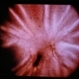 Massive Vitreous Retraction Massive Vitreous Retraction