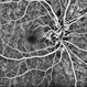 Peripapillary Vascular Loops Peripapillary Vascular Loops