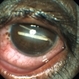 Multiple Intra Ocular Foreeign Body Multiple Intra Ocular Foreeign Body