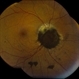 Not All Vitreous Seeding Represents Malignancy: Case of Melanocytoma Not All Vitreous Seeding Represents Malignancy: Case of Melanocytoma