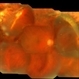Buckle intrusion with Retinal detachment Buckle intrusion with Retinal detachment