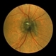 Optic Disc Melanocytoma Optic Disc Melanocytoma