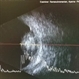 Retinoblastoma Ultrasound Retinoblastoma Ultrasound