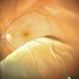 Retinal Detachment Retinal Detachment