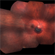Commotio Retinae with Retinal Hemorrhages
