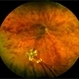 Central Retinal Vein Occlusion Central Retinal Vein Occlusion