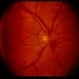 Optic Disc Hemorrhage