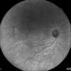 Central Serous Chorioretinopathy in Pregnancy. OD-IR