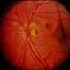 Peripapillary CNVM / Uveitis Peripapillary CNVM / Uveitis
