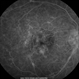 Idiophatic vasculitis OD