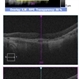 Pentosan Polysulfate Maculopathy Pentosan Polysulfate Maculopathy