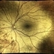 Oguchi Disease OS Oguchi Disease OS