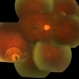 Montage of the Fundus Depicting the IOFB in the Inferotemporal Region
