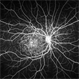 Stargard's Disease Stargard's Disease