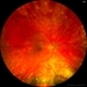 Sunset Glow Fundus Sunset Glow Fundus