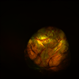 Right Eye Coloboma