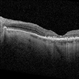 Plaquenil toxicity