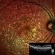Crystalline Retinopathy Crystalline Retinopathy