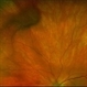 Varix of Vortex Vein - Optos Photo - Holding Superonasal Gaze Varix of Vortex Vein - Optos Photo - Holding Superonasal Gaze