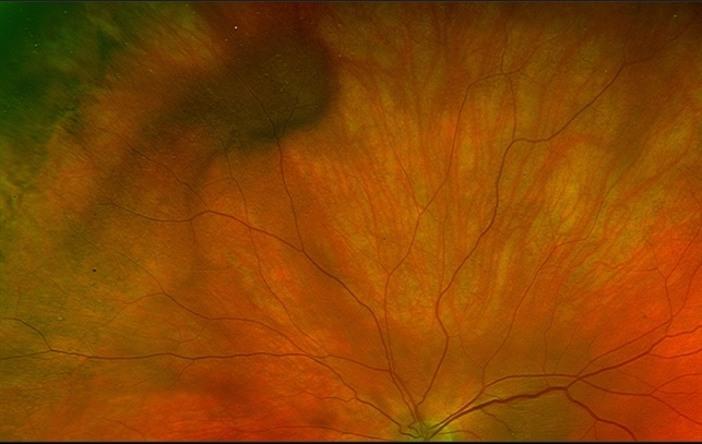 Varix of Vortex Vein - Optos Photo - Holding Superonasal Gaze - Retina ...
