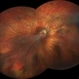 Macular dragging OD due to cicatricial ROP Macular dragging OD due to cicatricial ROP