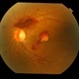 Premacular Hemorrhage in Acute Myeloid Leukemia