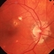Ocular Histoplasmosis Ocular Histoplasmosis