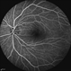 Asymptomatic Eye in FEVR