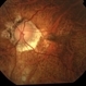Myopic Choroidal Neovascularization