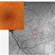AMN (Acute Macular Neurortinitis) AMN (Acute Macular Neurortinitis)