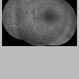 Paracentral Acute Middle Maculopathy