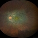 Bietti's Crystalline Dystrophy
