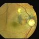 Polypoidal Choroidal Vasculopathy