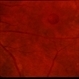 Macular Hole Evolving / Lamellar Hole Macular Hole Evolving / Lamellar Hole