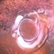 Dislocated  Lens (IOL) Lying on the Retina Dislocated  Lens (IOL) Lying on the Retina