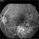 Choroidal Osteoma Choroidal Osteoma