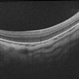 Flat Fovea in Oculocutaneous Albinism Flat Fovea in Oculocutaneous Albinism