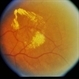 BDR / Macular Edema / Macroaneurysm BDR / Macular Edema / Macroaneurysm