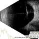 Intraocular Foreign Body Intraocular Foreign Body